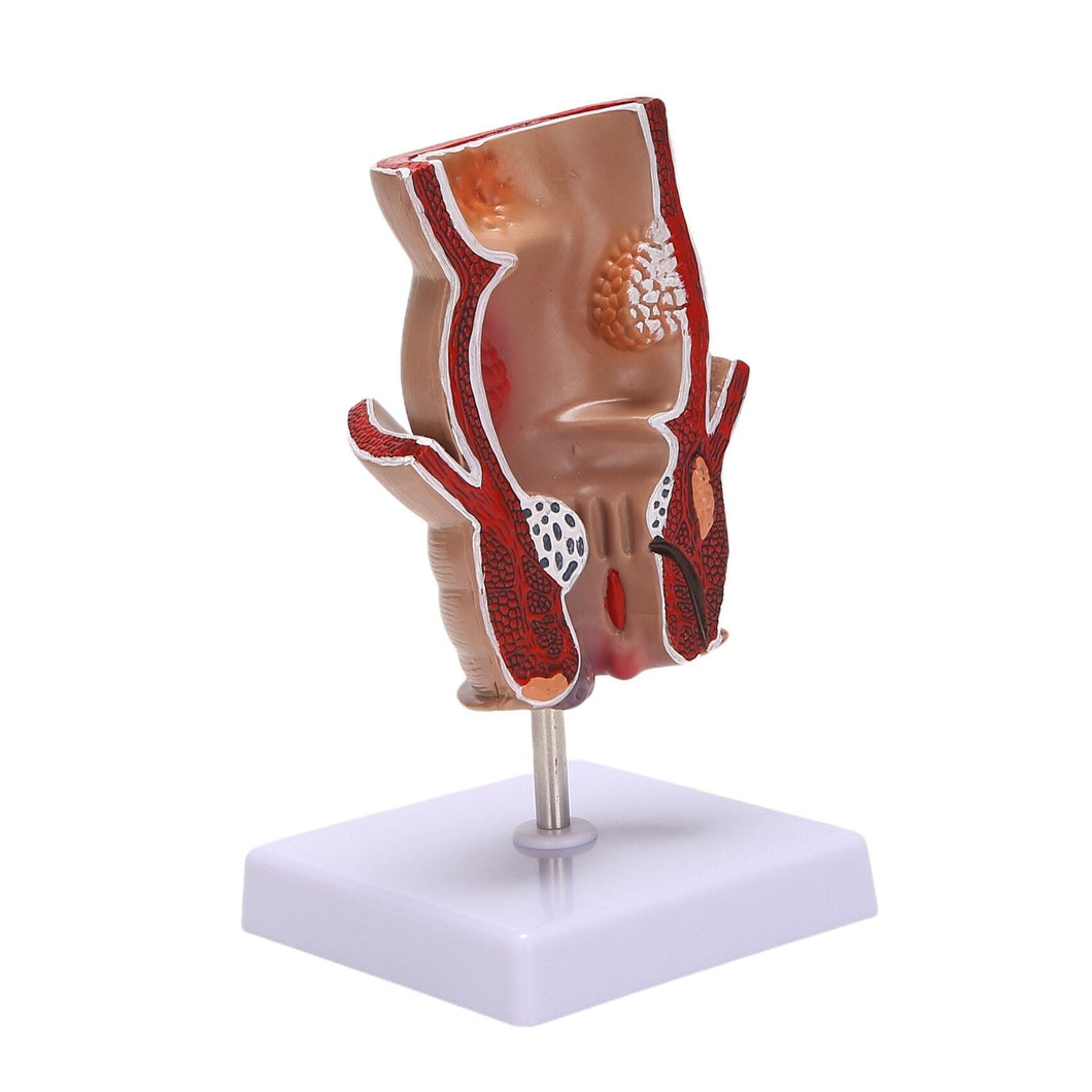 Human rectal haemorrhoid lesion model Haemorrhoidal fistula Fistula fissure Pathology teaching model