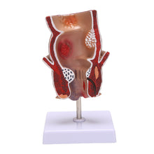 Load image into Gallery viewer, Human rectal haemorrhoid lesion model Haemorrhoidal fistula Fistula fissure Pathology teaching model
